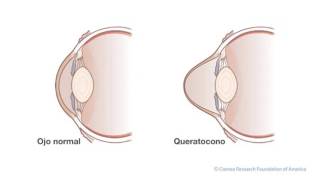 ojo con queratocono