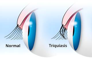 parpado con triquiasis