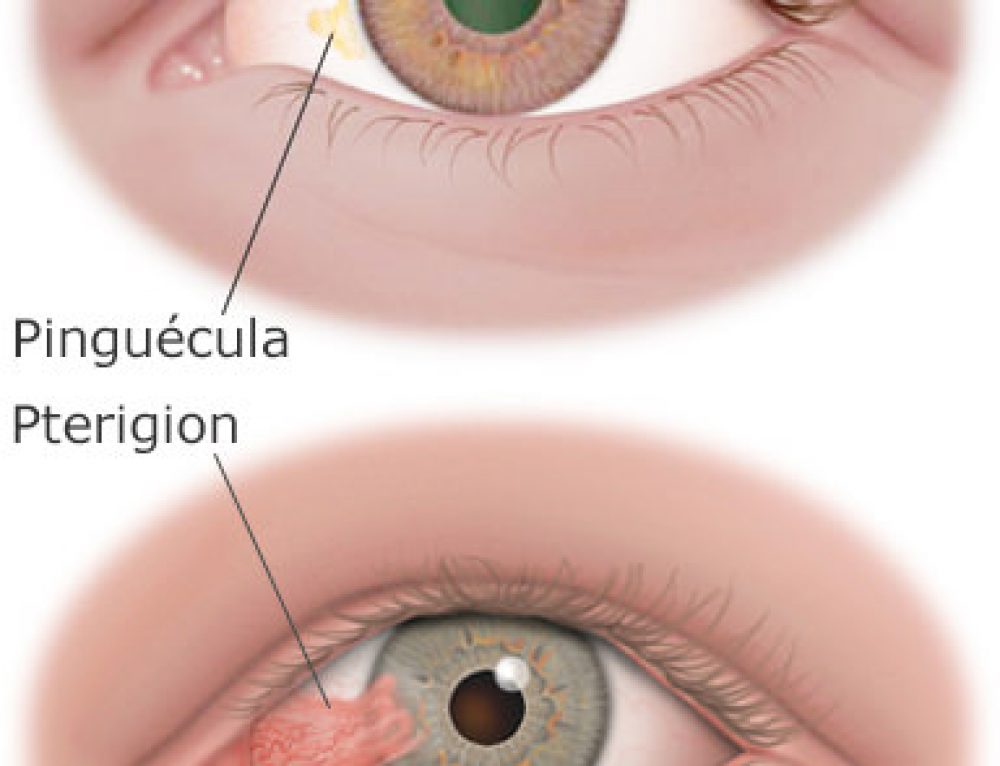 Пингвекула глаза фото симптомы и лечение Пингвекула глаз - Арт Минск.ру