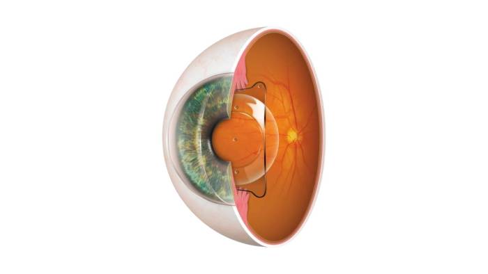 Lente intraocular ICL