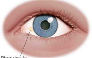 Pingueculitis Archivos - Vistaláser Oftalmología