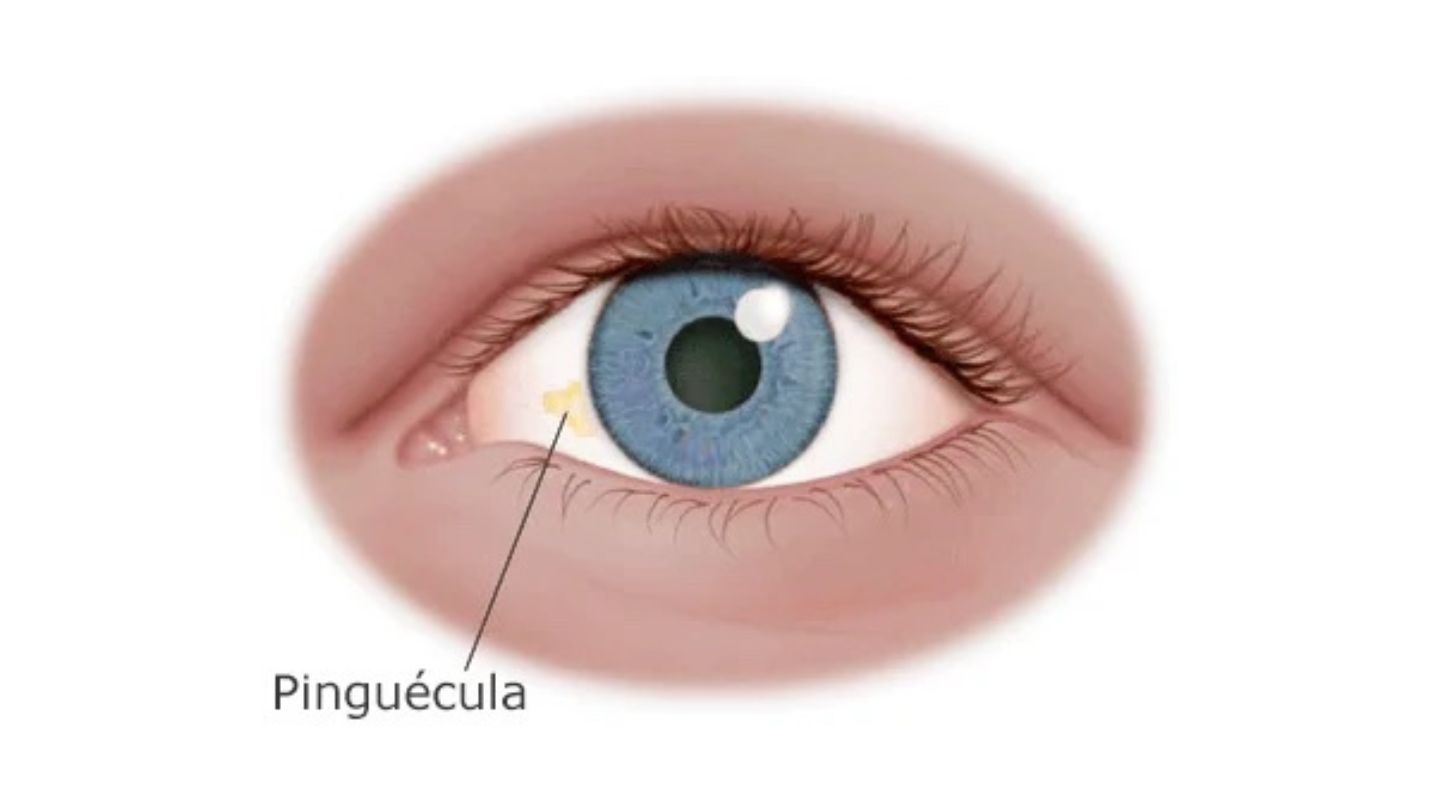 pinguecula en el ojo