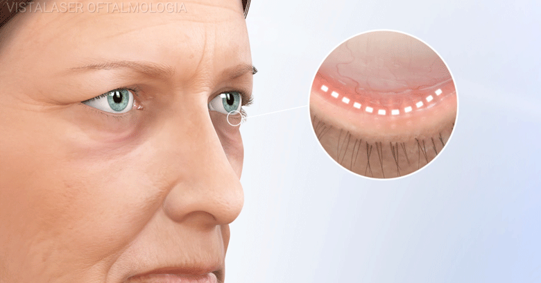 Cirugía Plástica Ocular por estética y salud ocular